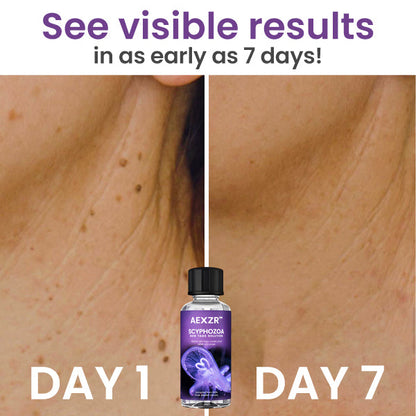 AEXZR™ Scyphozoa Skin Tags Solution - 🔥 Top Dermatologist Picks! Save Big with Limited-Time Deals! 💸