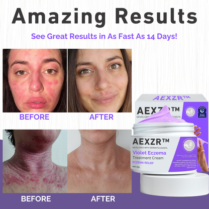 AEXZR™ Violet Eczema Treatment Cream - 👩‍⚕️ Recommended by board-certified dermatologist!